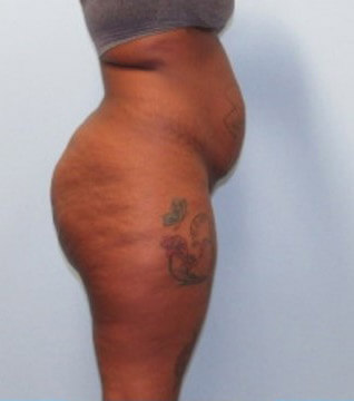 Liposuction Case 21