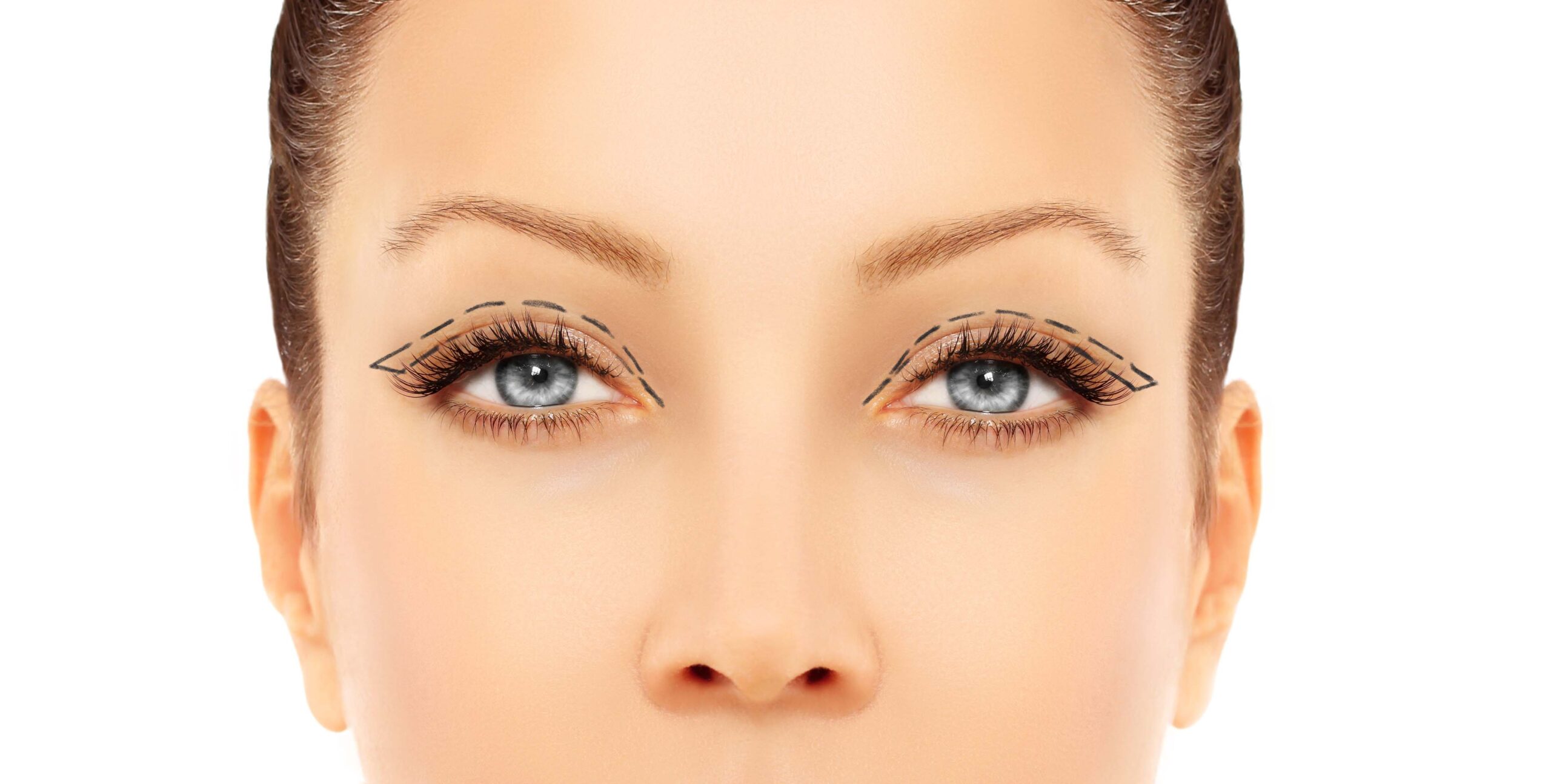 Marking the face.Upper-Eyelid Blepharoplasty Blepharoplasty (Eyelid Surgery) in Savannah, GA