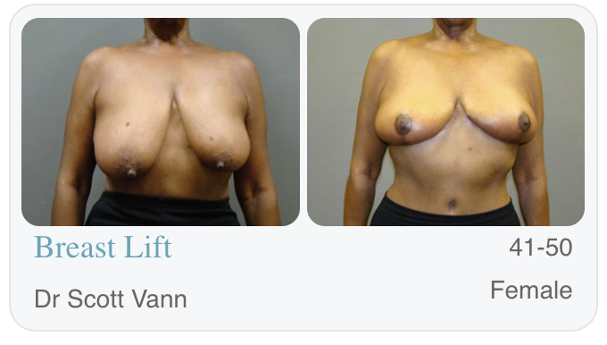 Best Breast Augmentation at SOWH Ardmore