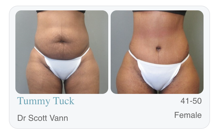 Tummy Tuck Savannah, GA